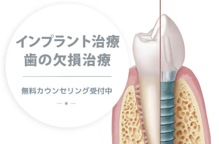 歯の欠損にインプラント治療。土日診療OK、無料カウンセリング受付中