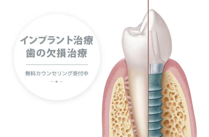 歯の欠損にインプラント治療。土日診療OK、無料カウンセリング受付中