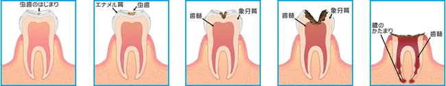 虫歯の進行イメージ