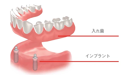 インプラント・オーバーデンチャーのイメージ