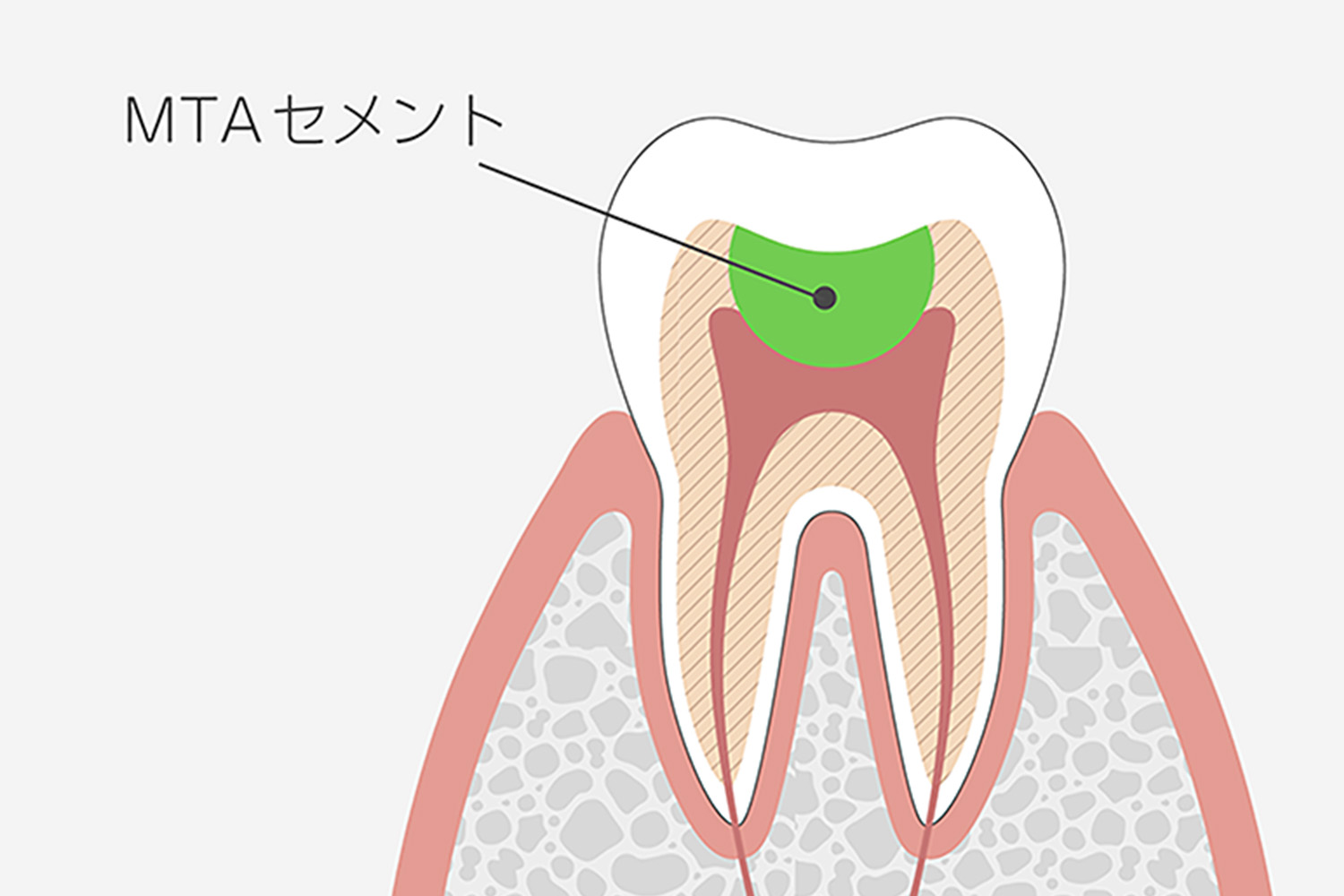 MTAセメントによる神経保護