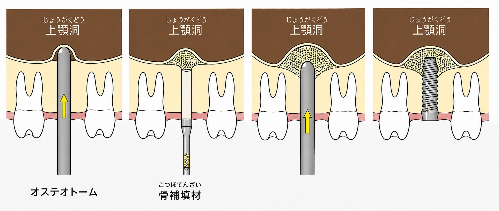 ソケットリフトの治療前後の比較