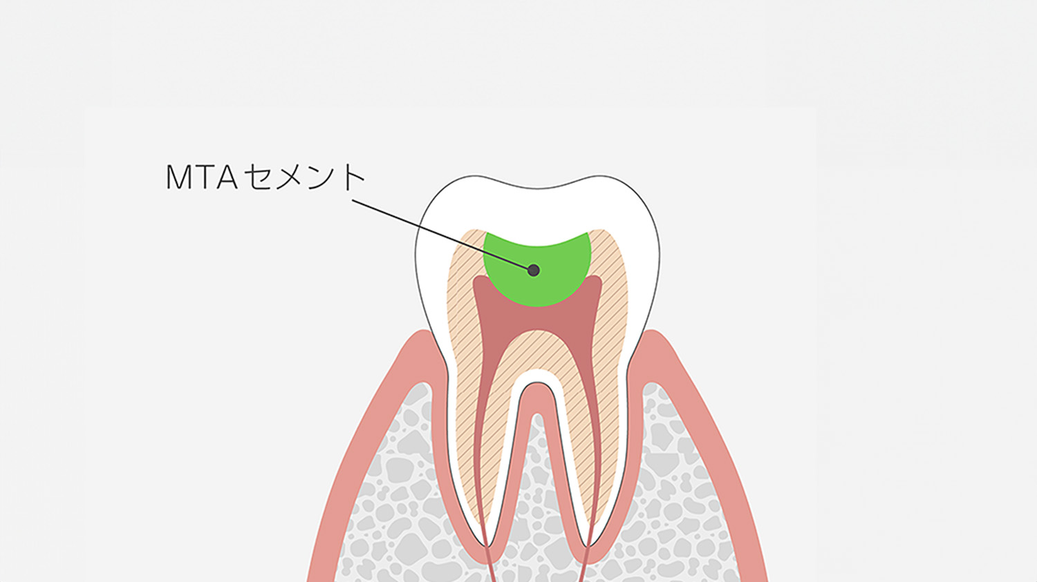 MTAセメントを用いた神経温存処置